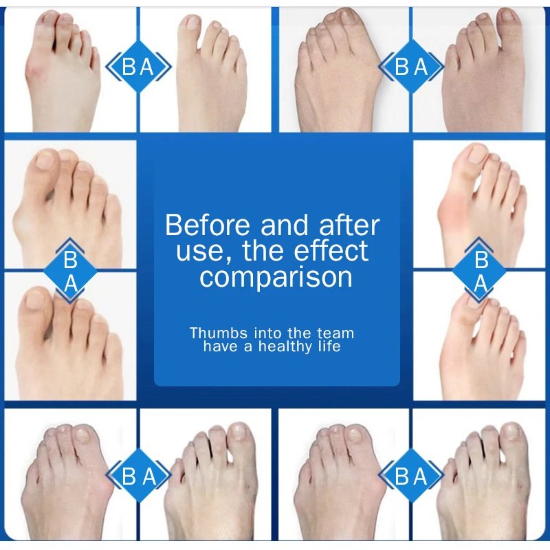 Big Toe Orthopedic Correction Device for Thumb Cystitis Thumb Care Orthotics Foot Pain Relief Bundle Splint Correction Device