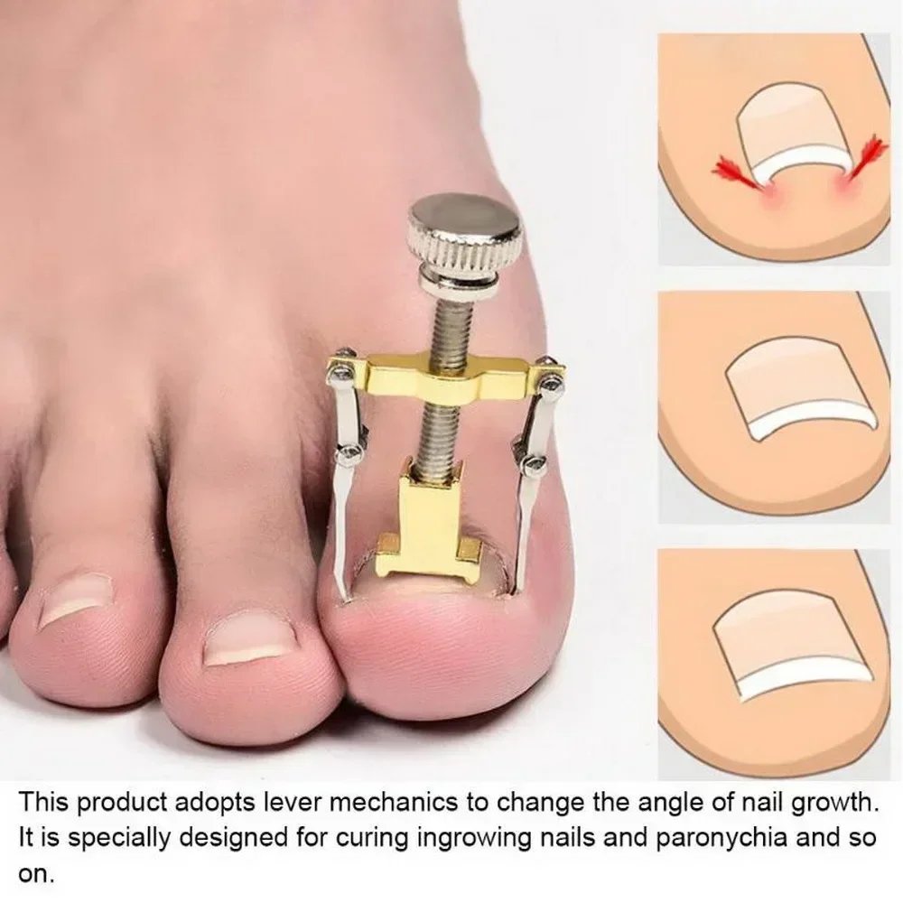 New Ingrown Toe Nail Recover Correction Tool Pedicure Toenail Fixer Foot Nail Care Tool Orthotic Nail Corrector Pedicure Tool