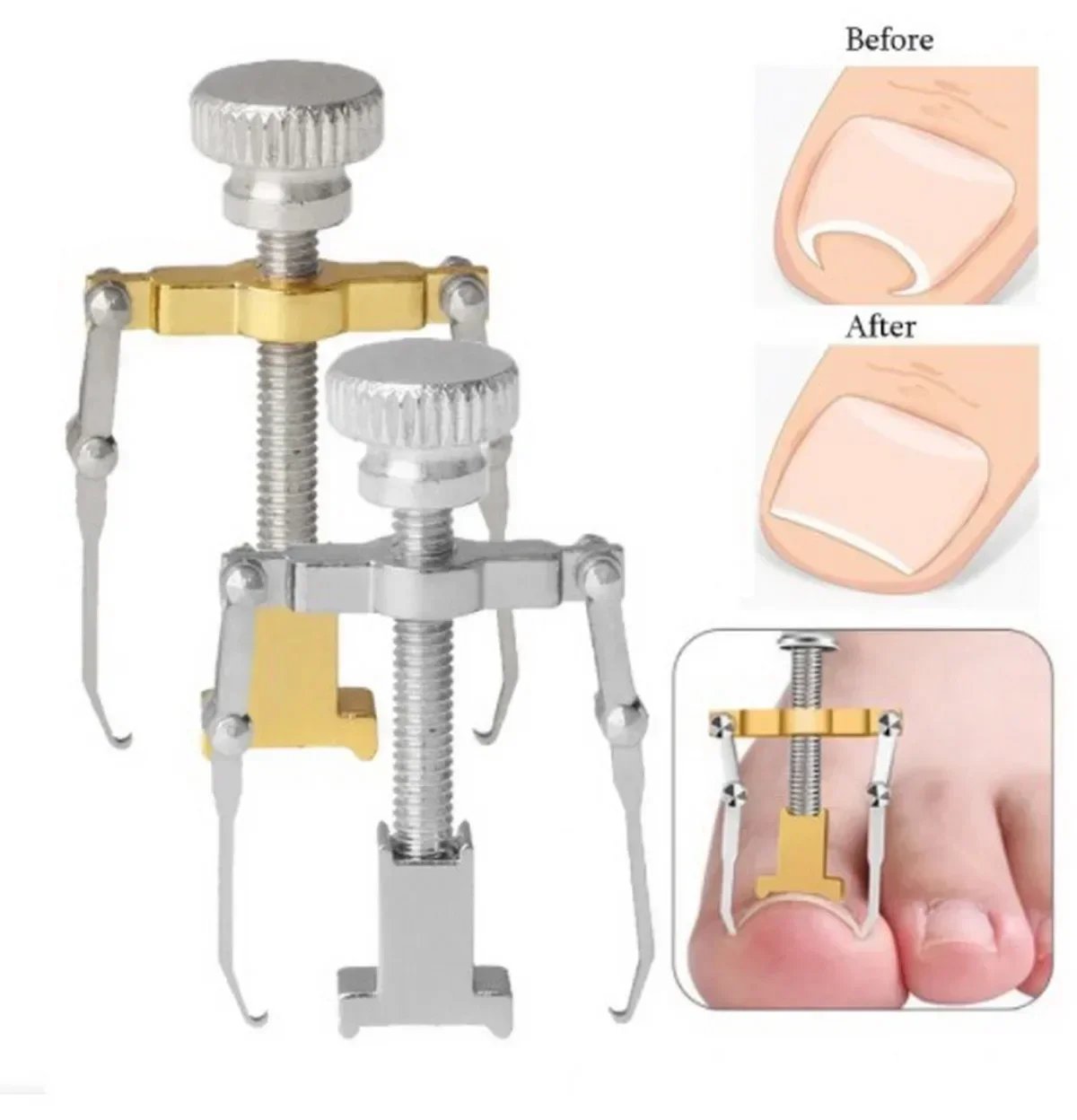 New Ingrown Toe Nail Recover Correction Tool Pedicure Toenail Fixer Foot Nail Care Tool Orthotic Nail Corrector Pedicure Tool