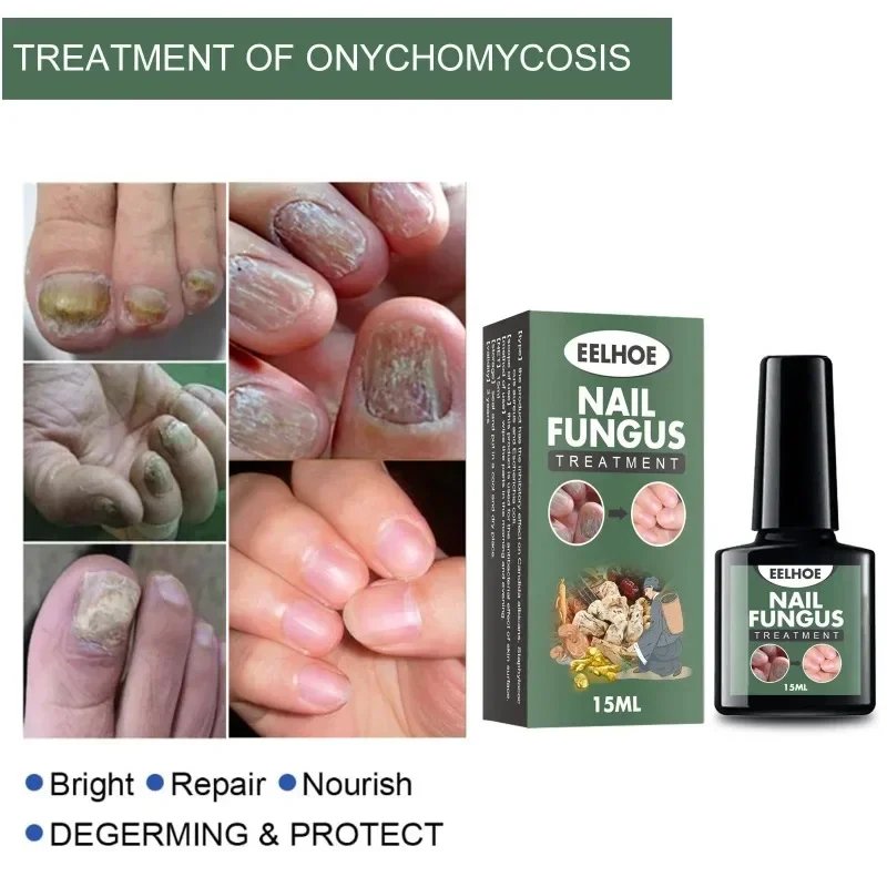 Nail Fungal Treatment Essence Oil Foot Toe Nail Fungus Removal Serum 7 Days Repair Onychomycosi Anti Infection Gel Care Products