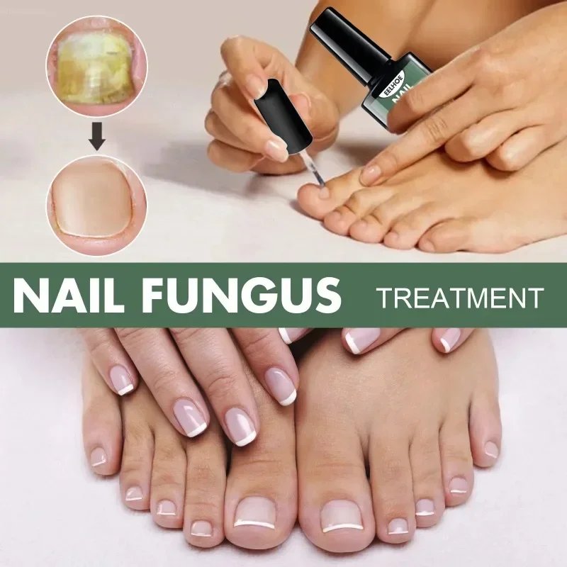 Nail Fungal Treatment Essence Oil Foot Toe Nail Fungus Removal Serum 7 Days Repair Onychomycosi Anti Infection Gel Care Products